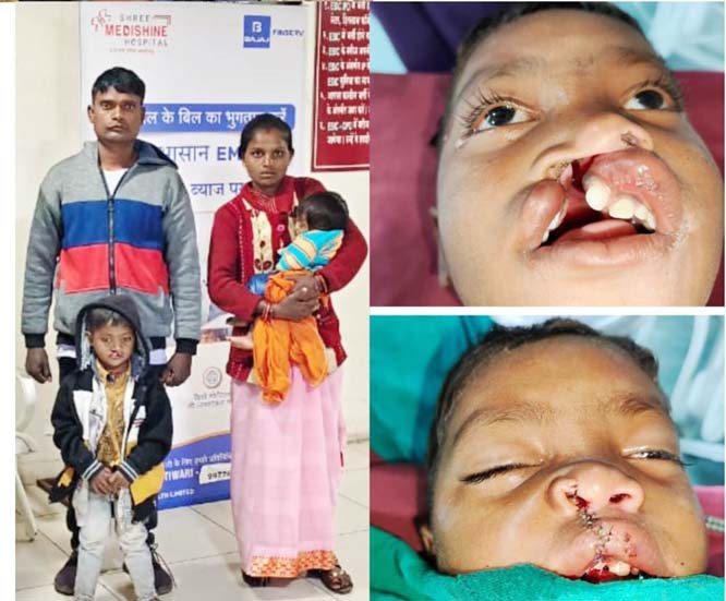 शासन की चिरायु दल के पहल पर जन्मजात फटे होंठ व तालु से विक्रम को मिली निजात