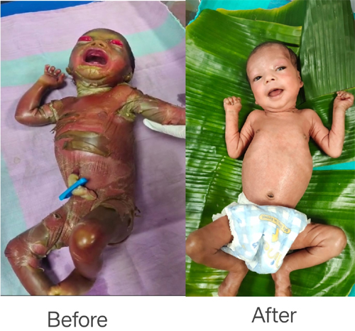 सुदूर बीजापुर में चिकित्सा चमत्कार, अत्यंत दुर्लभ बीमारी से जूझते शिशु को बचाया, केले के पत्तों से किया गया विशेष देखभाल